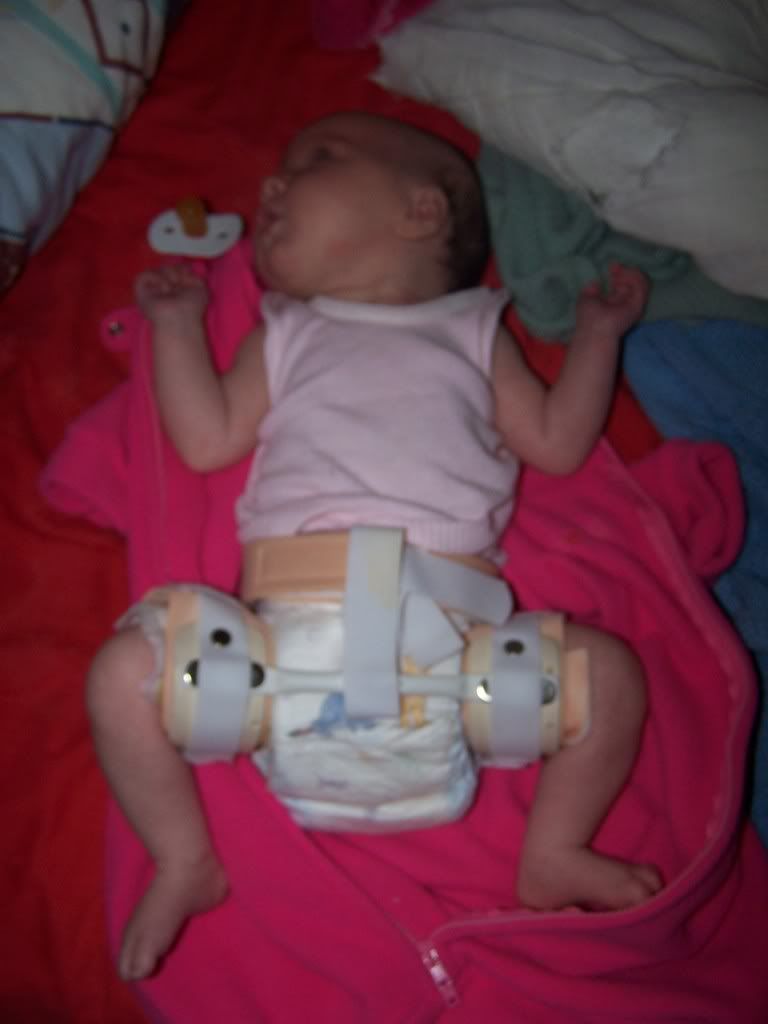 Hip kids/Hip Dysplasia Support Group Babies and Kids With