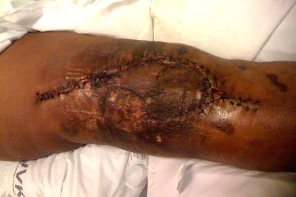 Reggie's knee...